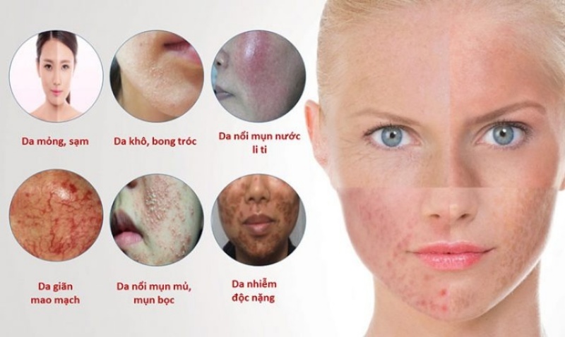 Dấu hiệu da bị nhiễm corticoid