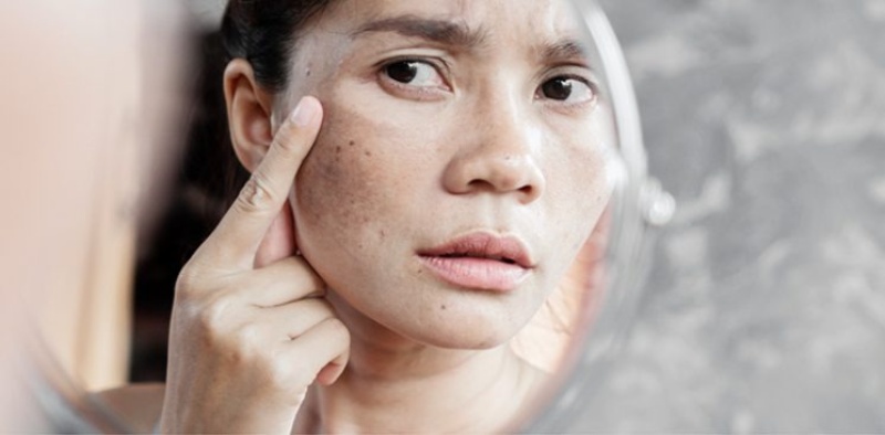 Đồi mồi trên da của phụ nữ làm nhiều chị em cảm thấy tự ti