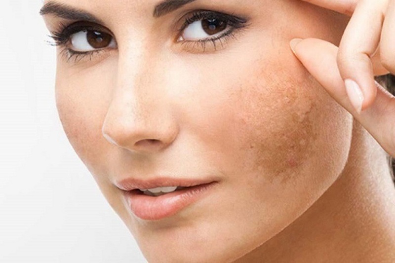 Thiếu hụt collagen là nguyên nhân khiến da dễ lão hóa và dễ bị nám đen