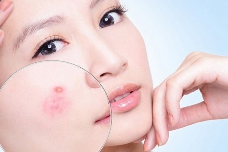 Xông mặt bằng lá trà xanh hỗ trợ ngăn ngừa và điều trị mụn nhọt