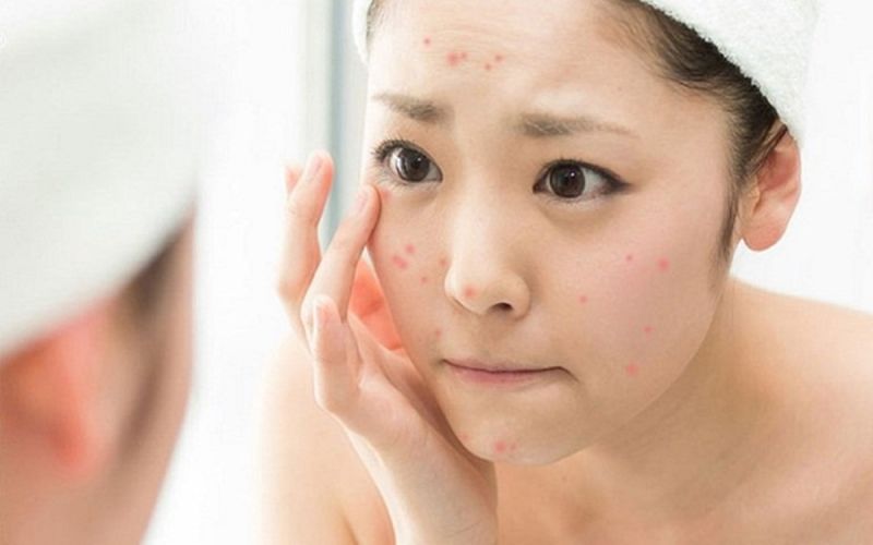 Uống collagen có thể gây nổi mụn