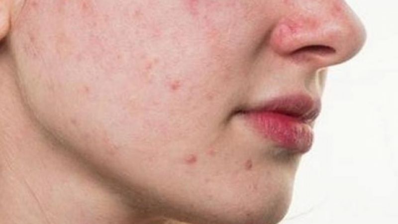 Dấu hiệu nhận biết của tình trạng da mặt nổi mẩn đỏ ngứa