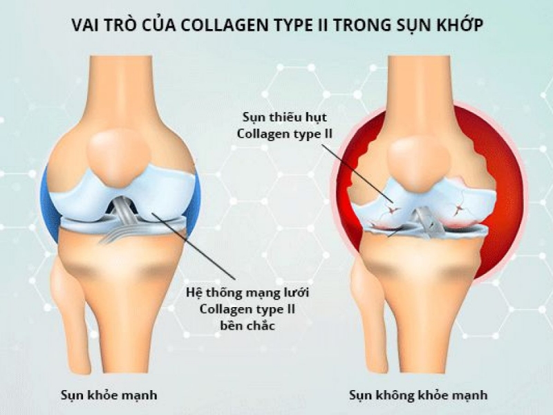 Collagen cải thiện tốt tình trạng đau nhức khớp xương. Ảnh: Internet