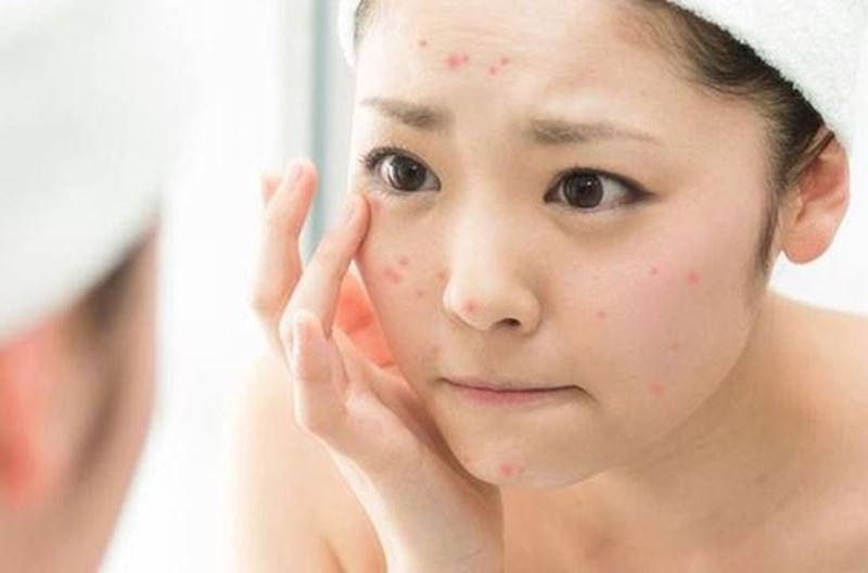 Da nhạy cảm rất khó chăm sóc