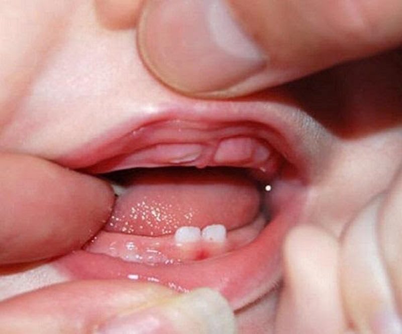 Mọc răng thường gây sốt ở trẻ. Ảnh: Internet