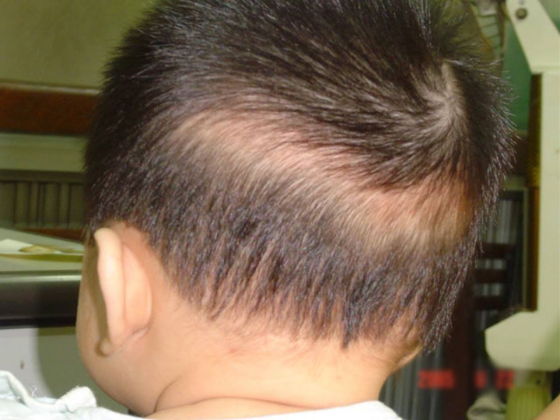Tình trạng rụng tóc vành khăn ở trẻ sơ sinh, trẻ nhỏ. Ảnh: Internet