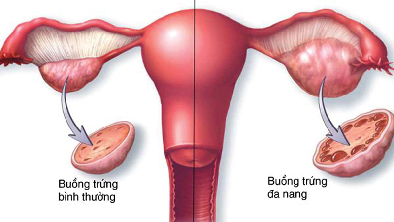 U nang buồng trứng là bệnh thường gặp ở phụ nữ