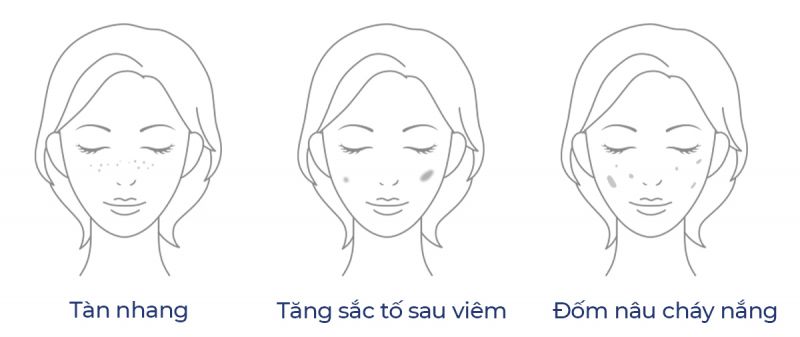 Viên uống Transino xanh hiệu quả với tàn nhang, thâm sau viêm mụn, đốm nâu cháy nắng