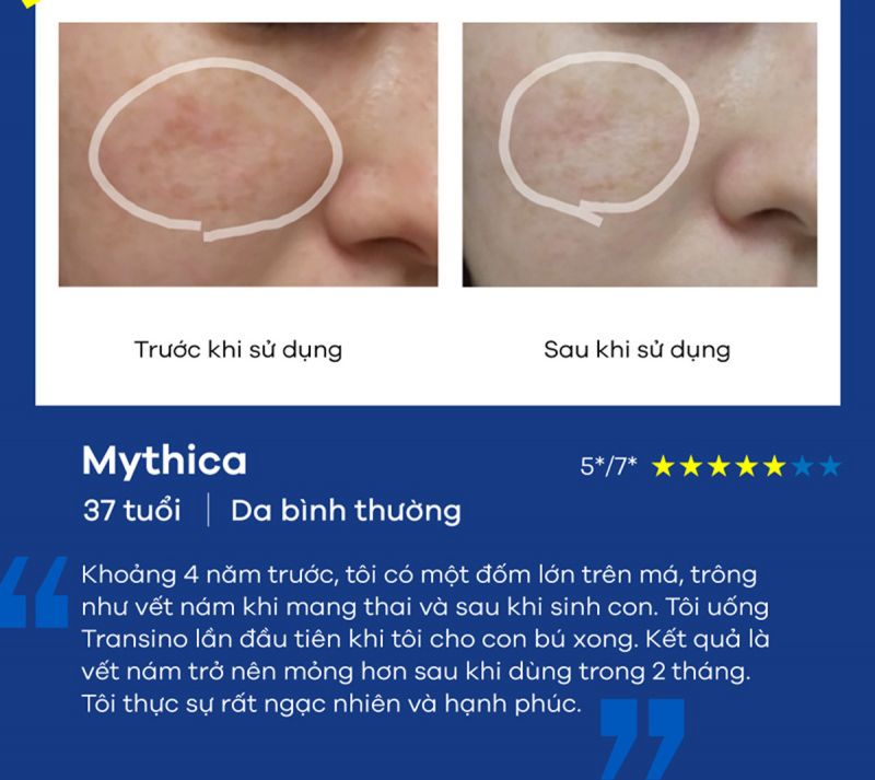 Có nên uống viên trị nám Transino không?