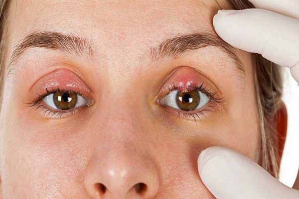 Lẹo mắt là vi khuẩn trú ngụ tạo thành ổ trên mí mắt 