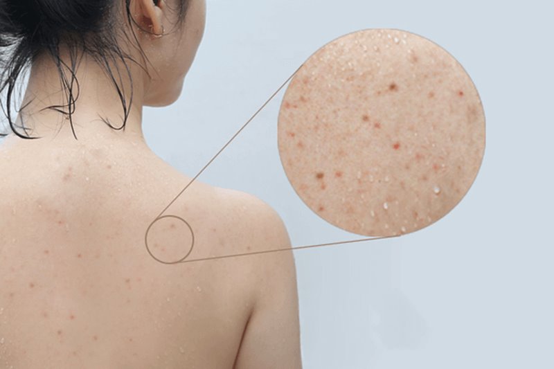 Có rất nhiều nguyên nhân gây ra tình trạng mụn lưng