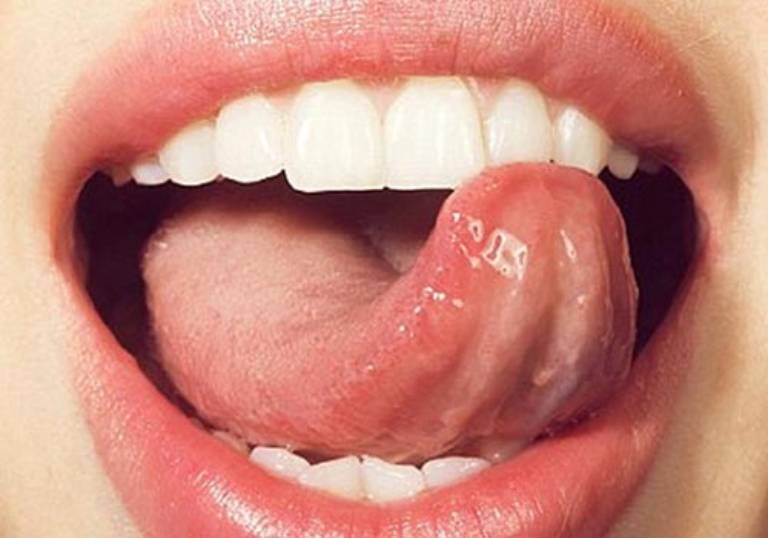 Nếu bạn đang gặp phải vấn đề về cuống lưỡi nổi mụn thịt, hãy xem qua hình ảnh để tìm hiểu thêm về nguyên nhân và cách điều trị. Đây có thể là dấu hiệu của nhiều căn bệnh khác nhau, nhưng luôn có thể chữa trị được. Hãy đến bác sỹ để được tư vấn chính xác và hỗ trợ.