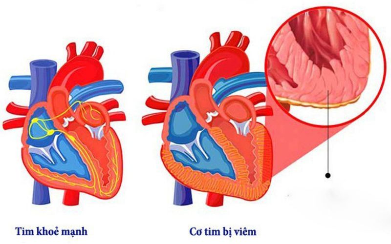 Bệnh viêm cơ tim