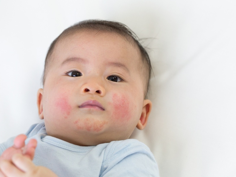 Cha mẹ có thể dễ dàng quan sát thấy vùng da khô của bé sạm màu hoặc ửng đỏ, sờ vào thấy khô ráp  