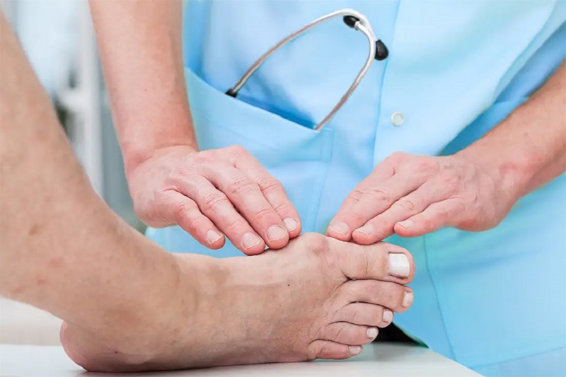 bệnh gout