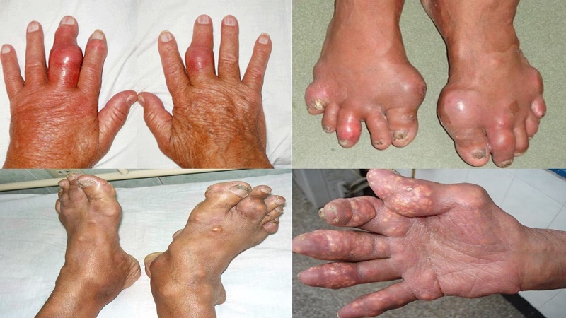 Biểu hiện bệnh gout