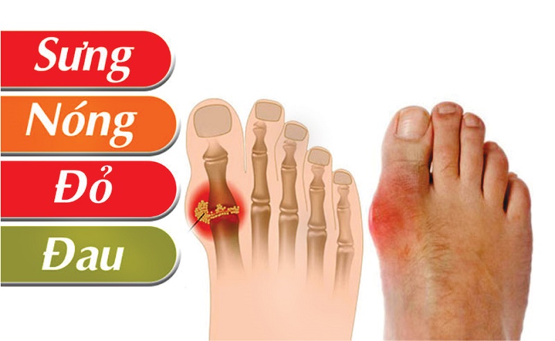 Gout thường tiến triển và gây ra các triệu chứng theo từng đợt