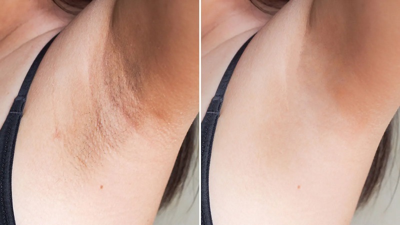 Top thuốc trị thâm nách của Nhật tốt nhất hiện nay