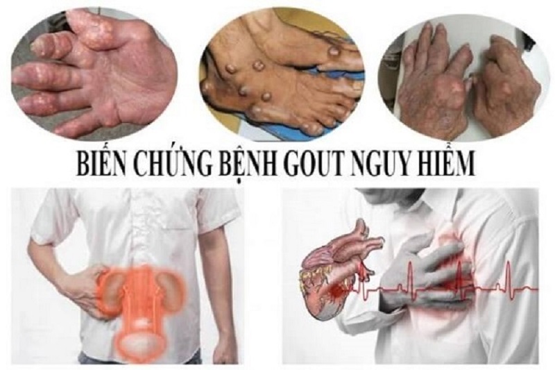 Người bị bệnh gút sống được bao lâu