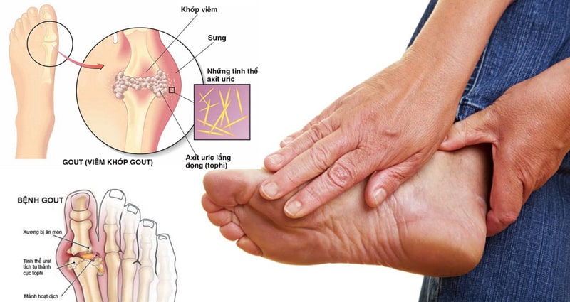 Thuốc điều trị gút và các bệnh xương khớp nổi tiếng của Nhật