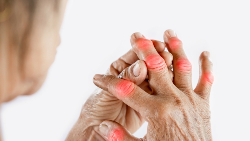 Gout bản chất là một loại viêm khớp mãn tính, thường gây đau và sưng ở các khớp