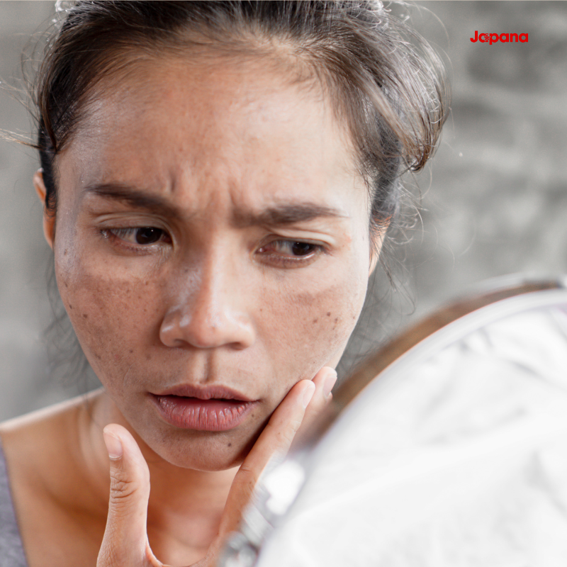 Nám mảng, nám lâu năm là gì?