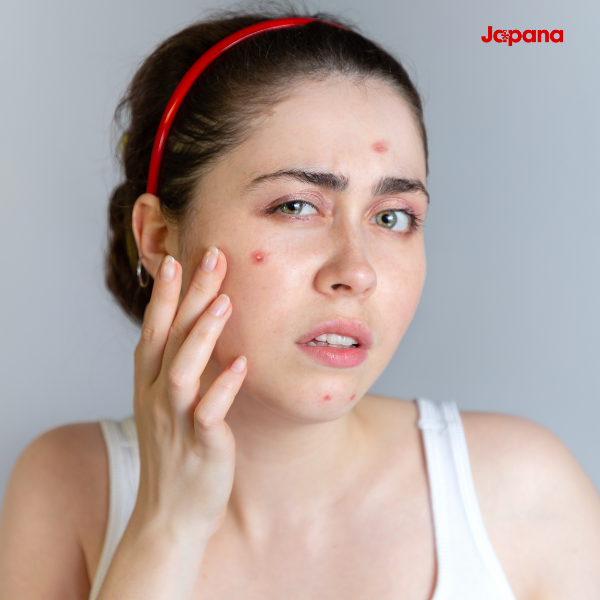 Uống collagen bị nổi mụn là do đâu?