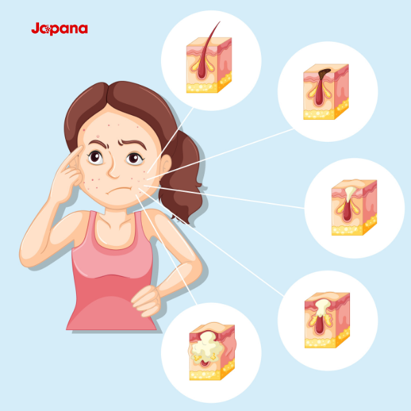 Nguyên nhân nổi mụn khi uống collagen