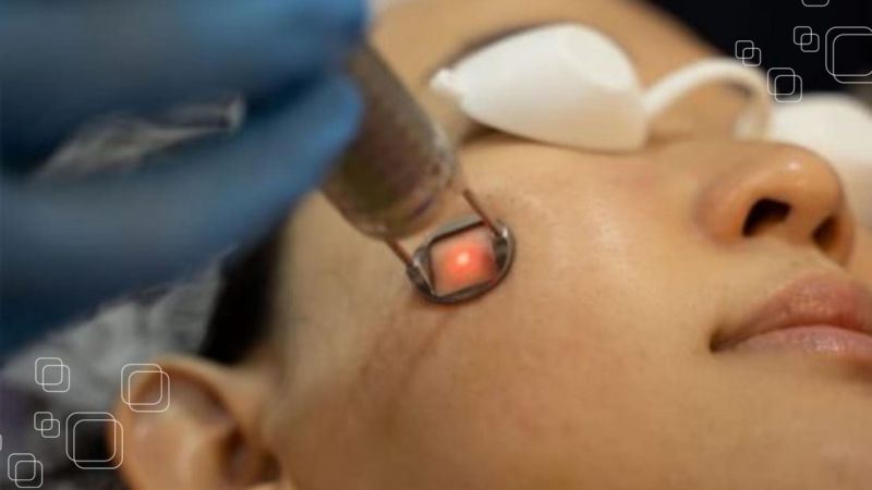 Điều trị nám da bằng bắn tia laser có tốt không?