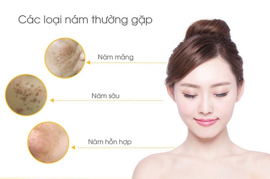 Các loại nám da thường gặp