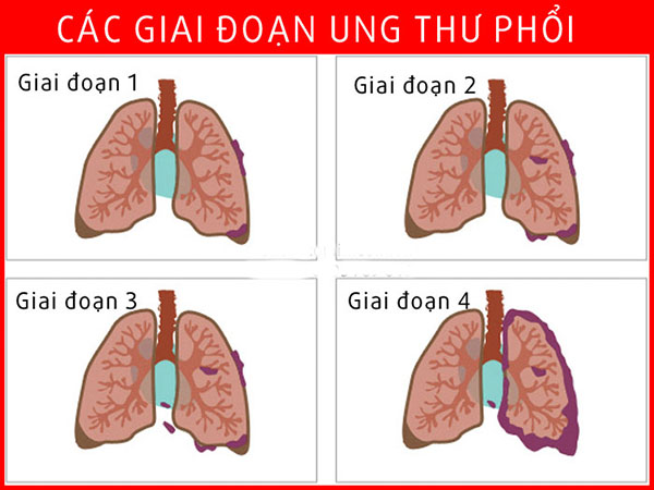 cac-giai-doan-cua-ung-thu-phoi