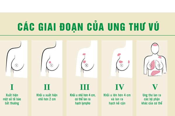 cac-giai-doan-cua-ung-thu-vu