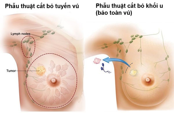 phau-thuat-ung-thu-vu