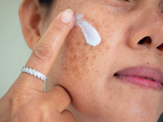 cách điều trị nám tốt nhất hiện nay
