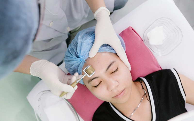Phương pháp lăn kim trị nám