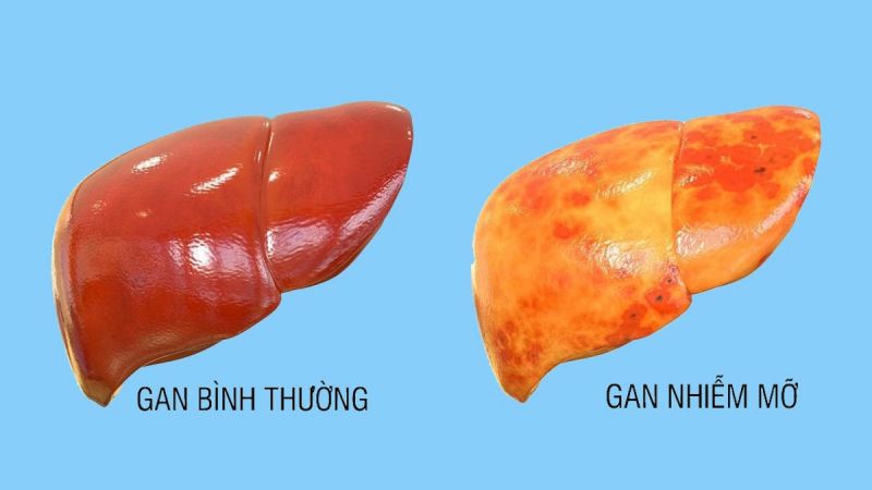 dấu hiệu bị nóng gan