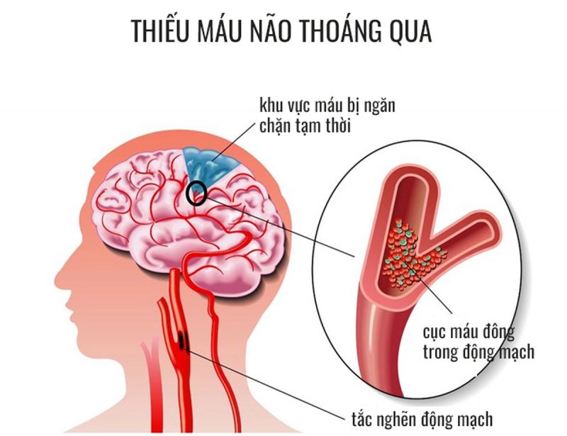 Cơn thiếu máu não thoáng qua báo hiệu nguy cơ cao đột quỵ