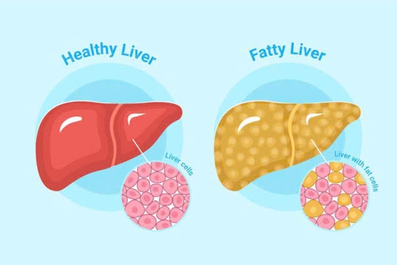 Tránh gia vị cay nóng để giảm kích thích gan