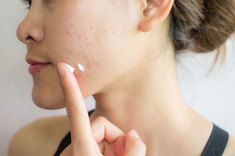 Khi trị mụn, bạn nên chú ý giữ da luôn sạch sẽ, hạn chế vi khuẩn gây hại xâm nhập