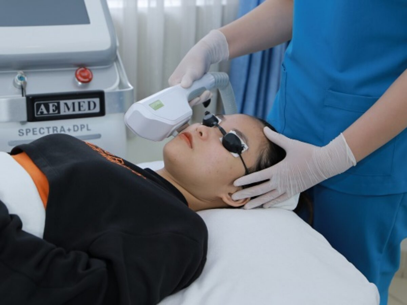 Laser điều trị nám da