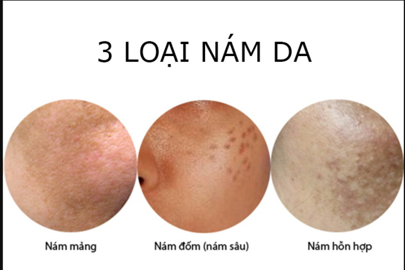 3 loại nám da 