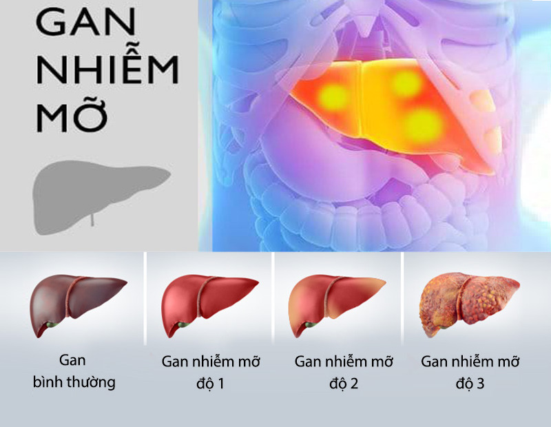 thuốc điều trị gan nhiễm mỡ độ 2