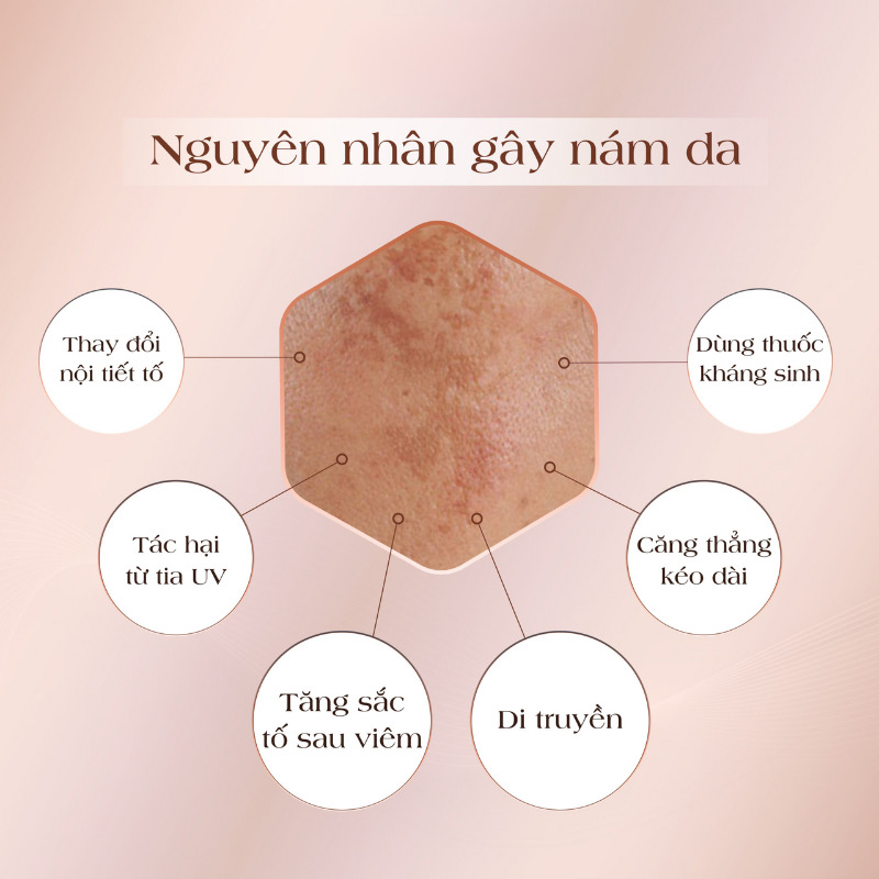 Nguyên nhân gây nám da