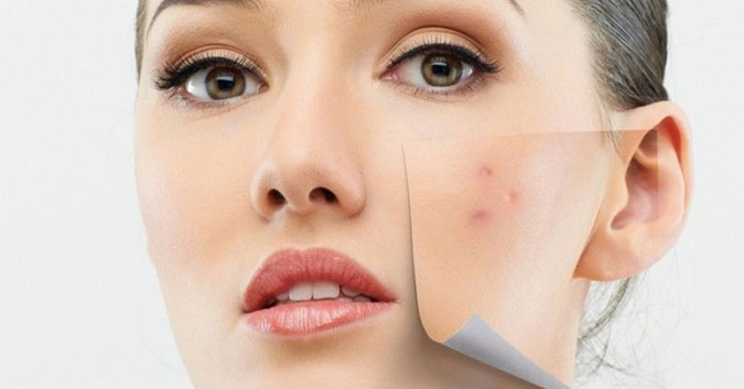 Nguyên liệu thiên nhiên trị thâm mụn tại nhà có hiệu quả như lời đồn