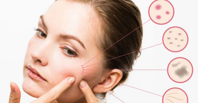 Những nguyên tắc vàng trị mụn thâm bạn cần biết rõ