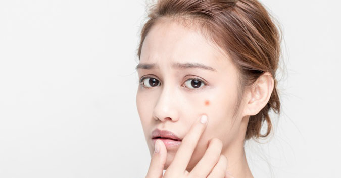 Bí quyết cho cả chàng và nàng chăm sóc da mụn ở tuổi dậy thì
