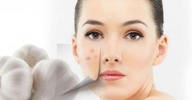 Trị mụn viêm ở tuổi 30 siêu hiệu quả tại nhà, bạn đã biết cách chưa?