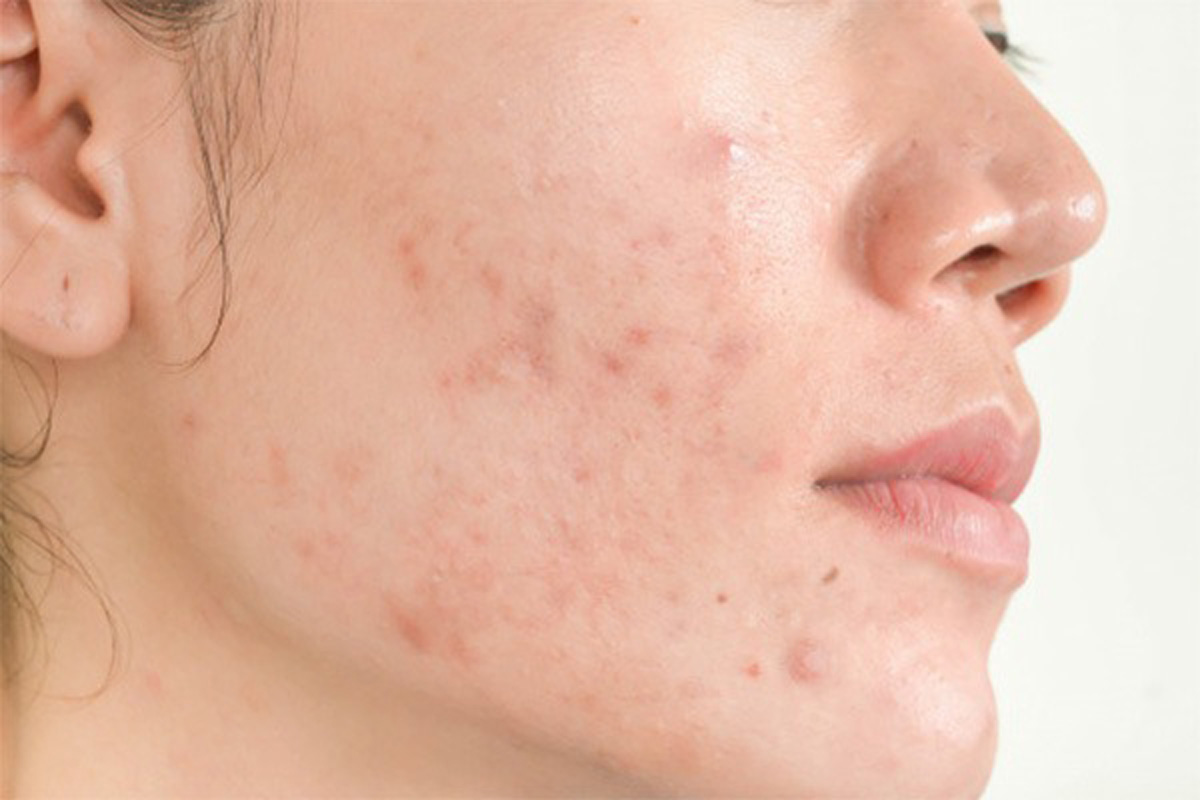Cách phục hồi da bị kích ứng do thời tiết và mỹ phẩm cực hiệu quả
