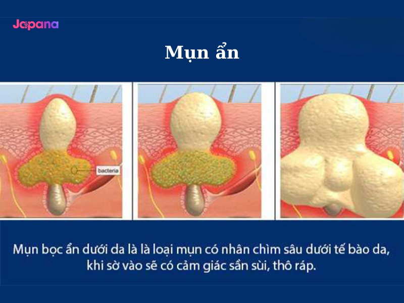 mụn ẩn