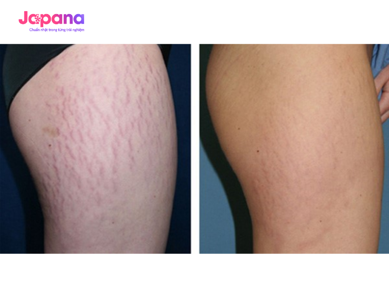 Rạn da ở háng là tình trạng phổ biến khi cấu trúc da bị đứt gãy